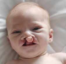 SLIKE KOJE ĆE VAM SLOMITI SRCE I VRATITI NADU U BOLJE SUTRA: Ova beba je  rođena sa deformisanom usnom i nepcem, a kada vidite šta su roditelji  uradili za nju... LJUBAV PREMA