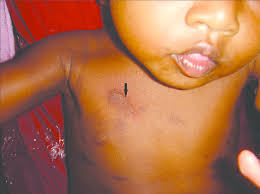 Image result for Urticaria pigmentosa children