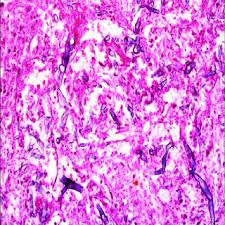 Rhizopus species are the most common causative organisms. Pdf Mucormycosis Of The Head And Neck