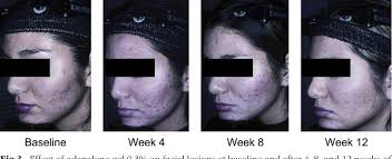 Figure 3 from Adapalene gel 0.3% for the treatment of acne vulgaris: a  multicenter, randomized, double-blind, controlled, phase III trial.