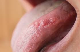 Read through for more information of how the bumps look like and available treatment oral leukoplakia appears as white patches on the mucus membrane lining the inside mouth, the tongue, mouth roof and inside cheeks. Leukoplakia Symptoms Causes Diagnosis And Treatment