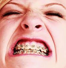 Braces Braces Are No Fun Fake Braces Dental Braces Brace Face