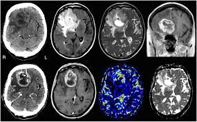 Metastatic tumors to the brain affect nearly one in four patients with cancer, or an estimated 150,000 people a year. Multimodality Assessment Of Brain Tumors And Tumor Recurrence Journal Of Nuclear Medicine