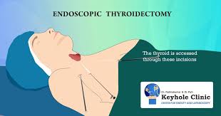 Endoscopic Thyroidectomy Thyroidectomy Thyroid Surgery Thyroid
