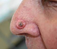 Stage refers to the extent of your cancer, such as how large the tumor is, and if it has spread. Squamous Cell Carcinoma Treatment Dr Walayat Hussain