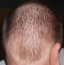 Causes or triggers can be a variety of factors from psychological and emotional stress, endocrine imbalances to nutrition and diet deficiencies. Hair Loss Treatment Delhi Care Well Medical Centre