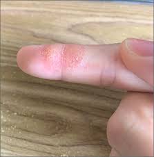 Index finger and forefinger mean the same thing, that is, the finger next to the thumb. Index Finger Plaque Mdedge Family Medicine