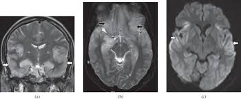 The changes spare the basal ganglia, a feature which is helpful in distinguishing an mca infarct with hemorrhagic transformation from herpes simplex encephalitis. Clinico Radiological Spectrum Of Bilateral Temporal Lobe Hyperintensity A Retrospective Review Abstract Europe Pmc