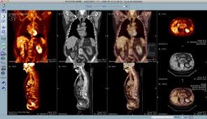 Pet Ct Scan Cost In Delhi 09999446542 Pet Ct Mri Pet Ct Scan Delhi Ncr 09999446542