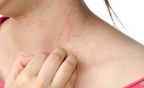 La Urticaria Que Es Remedios Caseros Para La Urticaria Ronchas En La Piel