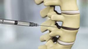 Injectable Discogenic Cell Therapy Developed To Alleviate Back Pain Technology Networks