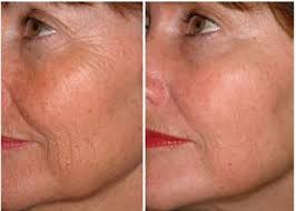 We did not find results for: Botox Barrie Martin S Rejuvenation Centre Microneedling