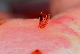 We did not find results for: Bed Bug Bites 8 Definite Symptoms Signs Treatment Strategy