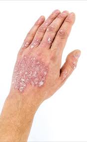 There are many ways to treat psoriasis, and your treatment plan will depend on the type of disease and how. Psoriase Dr Fabio Gontijo Dermatologista Bh