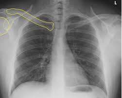 Image result for Chest XRay Interpretation