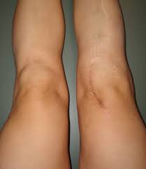 Pin On Knee Replacement Scars