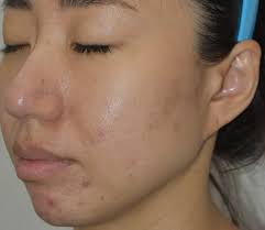 Лечение акне