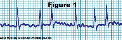 Ekg Rhythm Practice Quiz For Atrial Fibrillation Atrial Flutter