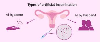 Jun 23, 2020 · the typical cost intracervical insemination (ici) performed at a clinic is $200 to $350 per attempt. What Is Artificial Insemination Ai Process Cost Types