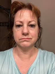 I just joined the YMCA! In 2014, I was hit from behind and my head and face  hit the steering wheel. I had two surgeries to repair my nose and I have