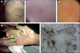 Image result for scabies transmission