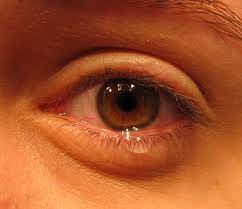 Zur genauen abklärung von augenbeschwerden ist ein besuch beim augenarzt grundsätzlich der richtige weg. Wenn Das Auge Juckt Und Trant Das Steckt Hinter Der Augengrippe