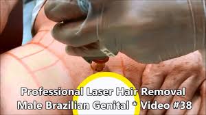 In laser removal, a doctor or dermatologist uses a laser device on your bare skin that sends concentrated light down to the hair follicles. Professional Laser Hair Removal Male Brazilian Genital Video 38 Youtube