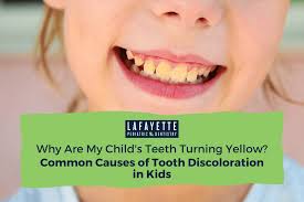 Image result for Tooth Discoloration
