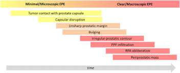 One in seven men in the united states will receive a prostate cancer diagnosis during his lifetime. T Staging Of Prostate Cancer Identification Of Useful Signs To Standardize Detection Of Posterolateral Extraprostatic Extension On Prostate Mri Clinical Imaging
