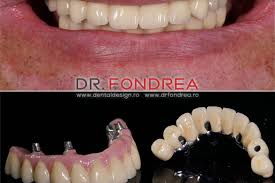 Pretul unei coroane dentare variaza intre 100 si 1200 de euro. Preturi Arhive Dr Bogdan Fondrea