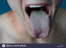 Enfermedad De La Lengua Fotos E Imagenes De Stock Alamy