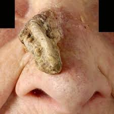 Image result for cornu cutaneum)