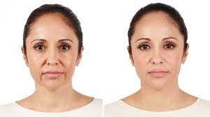 Maybe you would like to learn more about one of these? Radiesse Vs Juvederm What S The Difference