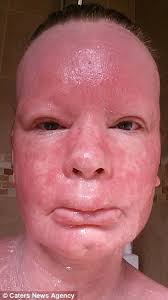 Extreme eczema sufferer has clear skin for the first time in her life
