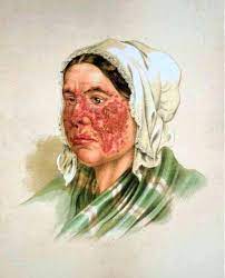 Aspects of lungs lesion with exanthematous lupus под ред. Lupus Erythematosus Wikipedia