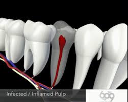 Maybe you would like to learn more about one of these? Http Www Reddit Com R Educationalgifs Comments 23nyc2 Root Canal Animation Dental Root Canal Oral Health Care