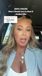 Replying to @Aimee Elizabeth Clar skin cancer story time! #skincancer  #basilcellcarcinoma #protectyourskin #getyourskinchecked #momsoftiktok  #womenover30 #cancersucks