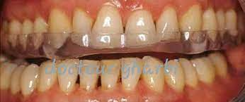 اقناع كنية نتروجين حك الاسنان buyandsellnapleswithnancy com