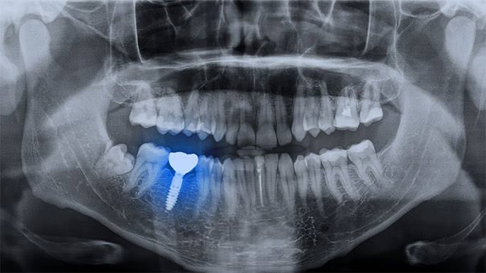Single tooth implant