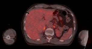 St paul hospital pet scan. Fdg Pet Ct Scan Demonstrating Bilateral Increased Fdg Activity In The Download Scientific Diagram