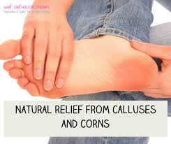 Calluses And Corns Are Areas Of Hardened Sometimes Yellowish Skin On The Foot They Form On Pressure Points Or Dry Skin On Face Dry Skin Diet Get Rid Of Corns