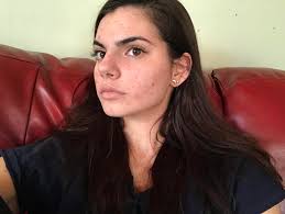 I started getting perms some at my dermatologists office. Acne My Hyper Pigmentation Makes Me Look Like I Have A Lot More Active Acne Than I Do What Should I Do Skincareaddiction