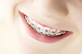 Our doctors at the 'brea pediatric dental practice and orthodontics' believe in educating the parents and providing preventive and comprehensive dental care to children of all ages. Specialized Orthodontic Treatment Just For Kids