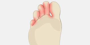 Athlete S Foot The Complete Injury Guide Vive Health