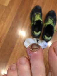 You will have to wait for a new nail to grow on that area. Runner S Toe Preventing And Treating Black Toenails Run With Strength