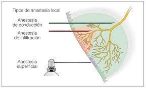 La Anestesia Local En Odontologia Quintessence Odontologia Tratamientos Odontologicos Exodoncia