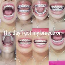 Hayyyaaaah It Hurts Like Fack I Kennot Huhuhuh Braces Tips Dental Braces Brace Face