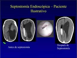 Las que sobreviven tienen grados diferentes de discapacidades intelectuales, físicas y neurológicas. Hidrocefalia Opciones Mas Recientes De Tratamiento Dr David Sandberg Youtube