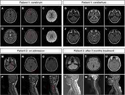 Frontiers | Identification of Anti-Collapsin Response Mediator Protein 2  Antibodies in Patients With Encephalitis or Encephalomyelitis