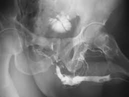 Image result for Retrograde Urethrogram